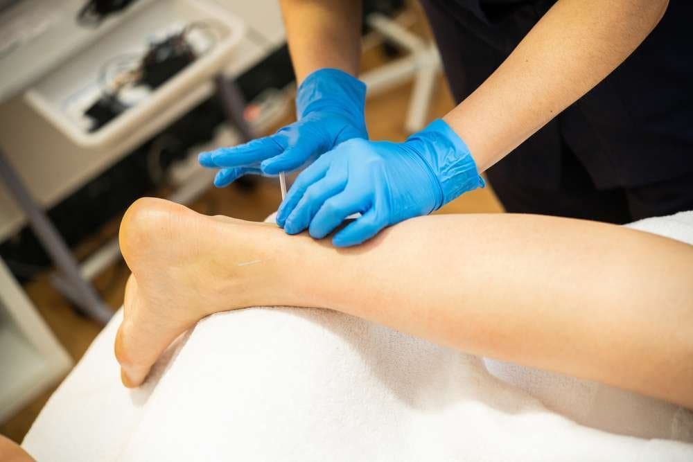 Séance de dry needling au cabinet : aiguille de puncture sèche appliquée sur un point gâchette musculaire